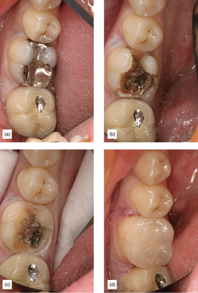 A large silver filling with caries to the final final supragingival restoration.