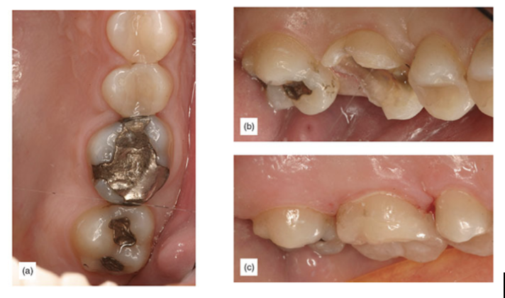 Deep gingival margin. (b) Removal of caries completed. (c) Final supragingival restoration.