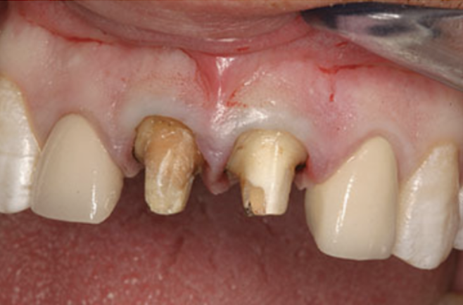 crown being cemented with resin modified glass ionomer cement has significant tooth removed and subgingival margins