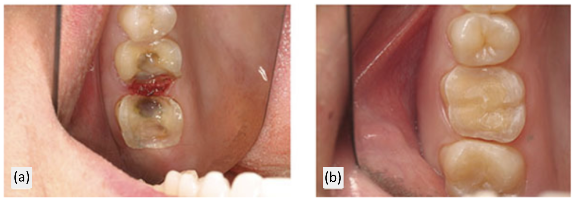 isolation when margins are supragingival compared to bleeding subgingival margins for bonded onlays