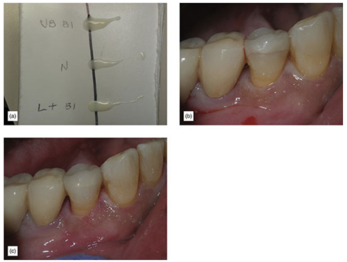 three drops of opacious, medium, and translucent cements