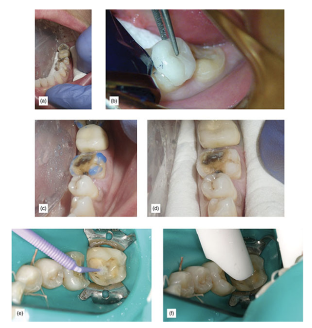 (a) Isolation. (b) Adjusting onlay. c) Selective enamel etching. (d) After drying, frosted enamel. (e) Applying primer. (f) Removing solvent.