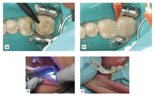 (g) Applying cement on onlay. (h) Removing excess using a gum messenger. (i) Light-cure onlay for one cycle. (j) Using a no.12 blade.