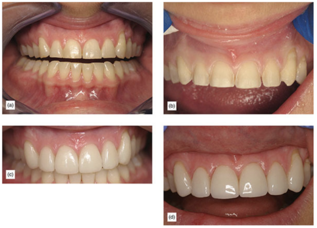 worn dentition treated with porcelain veneers (a) and with supragingival minimal preparation (b) has esthetic results (c), and even six years later, with some cervical margins, the results remain esthetic (d)