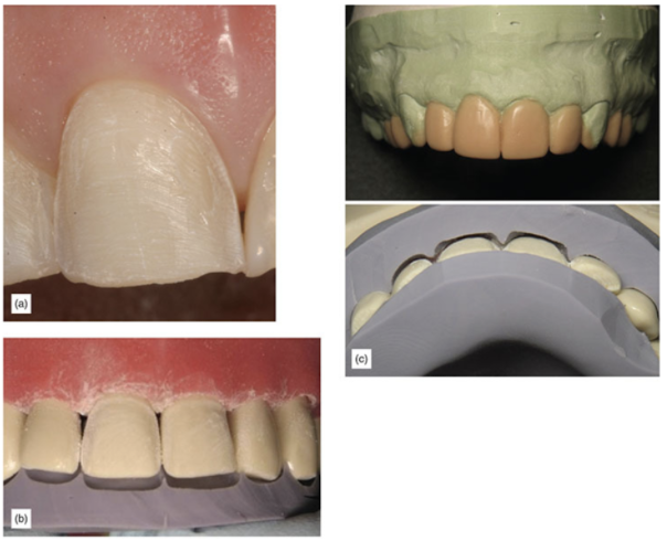 (a) Margins are close to the gum without touching it. (b) Silicon matrix. (c) Matrix created from the wax-up.