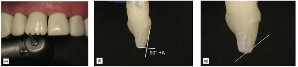 (e) Incisal edge depth cuts. (f) Incisal reduction 90 degrees for cervical aspect. (g) Incisal reduction gently rounded.