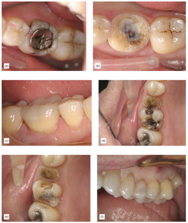 damaged tooth needing an indirect restoration (a), undisturbed gingiva during onlay preparation and showing very little tooth removal (b), healthy gingival around finished onlay (c), and badly damaged teeth (d)