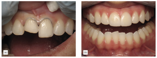 supragingival veneer preparation of a fractured tooth and adjacent central (a) followed by a healthy undisturbed gingiva around the finished veneers (b)