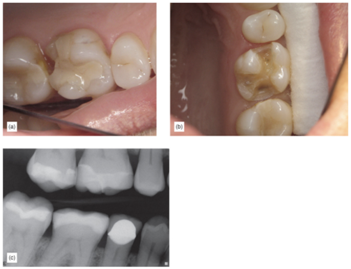 a tooth that may have been treated with a crown (a), then after supragingival minimally invasive preparation (b), and finally that same tooth 11 years postoperatively (c)