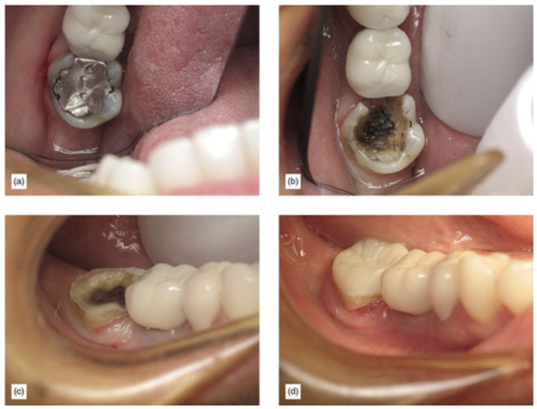 an extremely damaged tooth with amalgam (a) then the amalgam removed, and if axial reduction was performed the tooth would end up deeply subgingival (b). In image c, we see a preparation that is supragingival and easy to isolate an event on a second molar, followed by the finished restoration supported by adhesion (d)