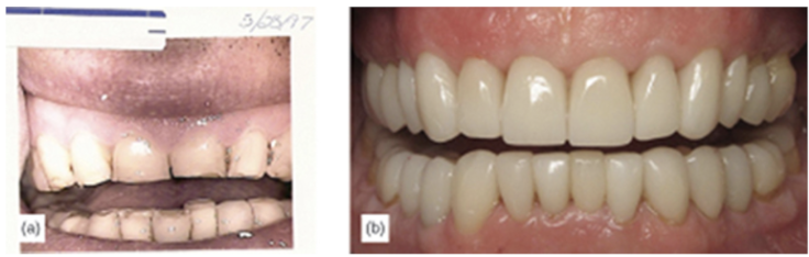 Rehabilitation using bonded onlays and veneers