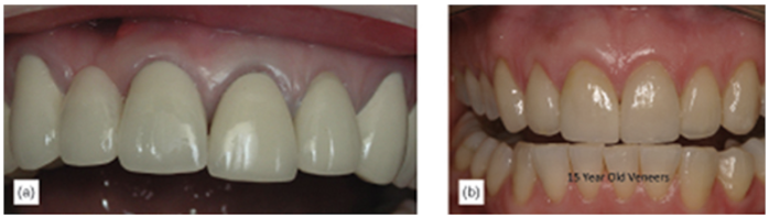 Veneers before and after