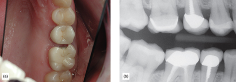 fractured veneer porcelain and x-ray