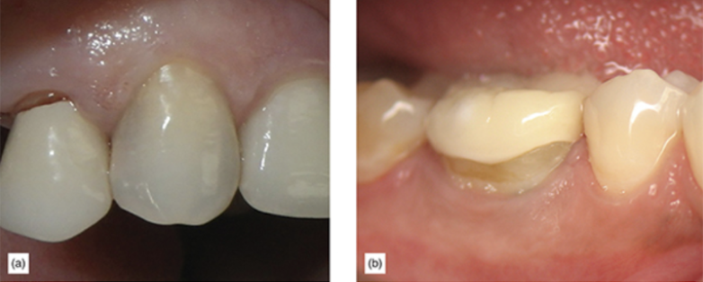 Unesthetic full zirconia crowns.