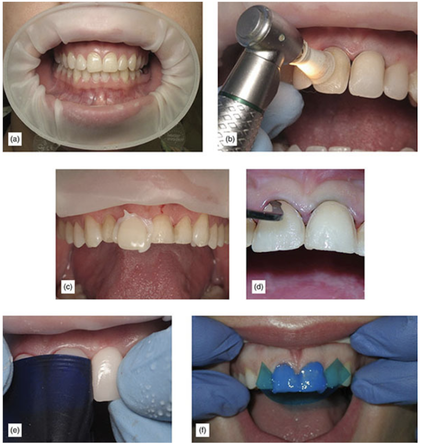 veneer cementation steps