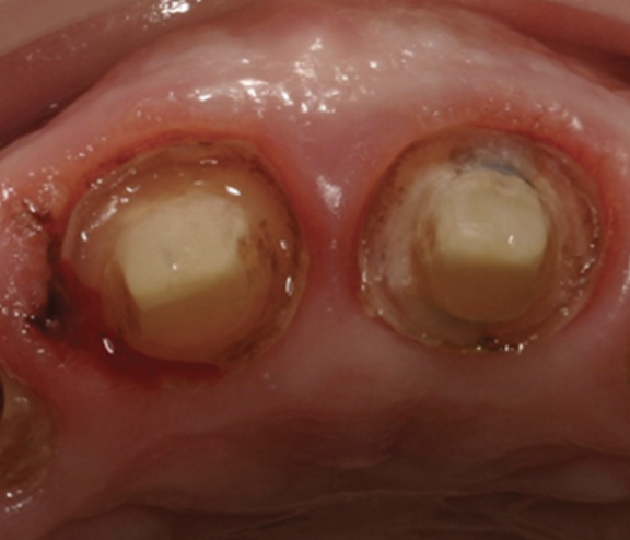 Subgingival margins are difficult to isolate.