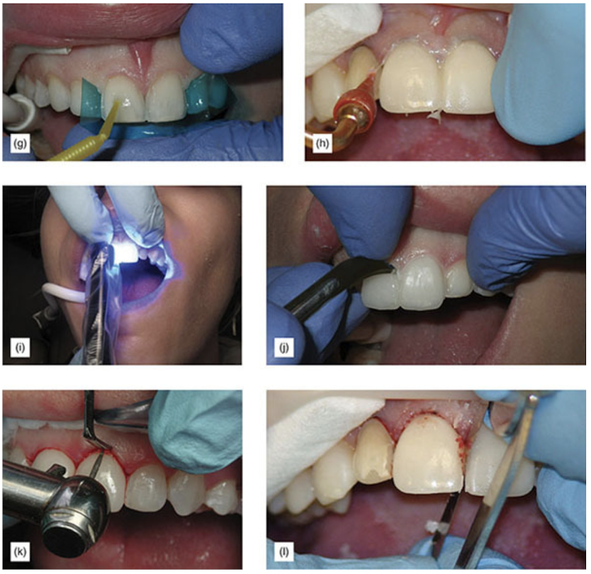 veneer cementation steps