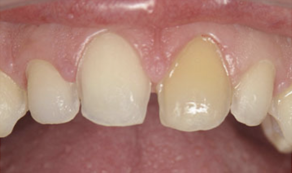 Difference in color on prepared teeth is very difficult and unpredictable to manage using different colored cements.