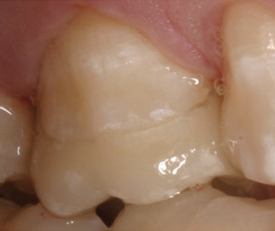 Observe, on the mesial margin of onlay cementation with clear cement, an apparent “gap”. In reality, the margin is closed, but the clear cement appears to be missing.